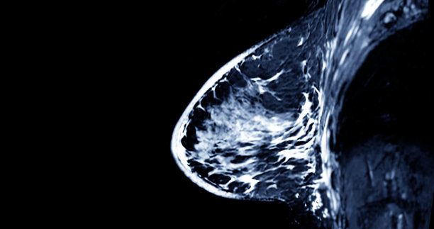 乳房透视,癌症,磁共振成象扫描