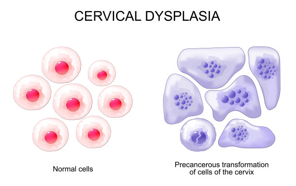 鳞状细胞癌,癌细胞,宫颈癌