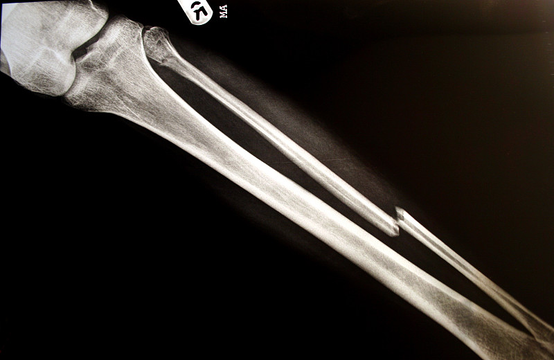 x光,腿,断腿,胫骨,x光片,腓骨,坏掉的,膝,医学扫描,身体受伤