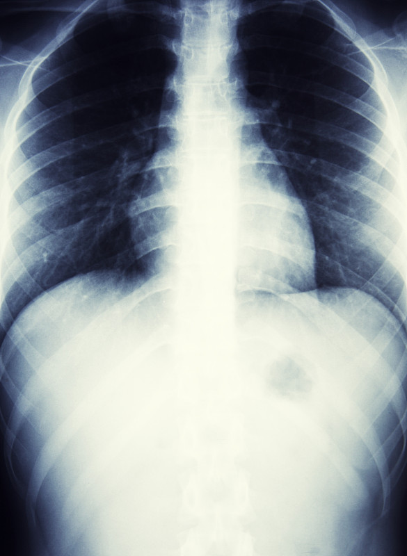 人类肺脏,x光,腹部,斜裂缝,椎胸肋骨,腰椎,肋间,椎体,腺泡,胸骨