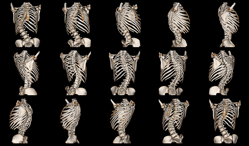 脊柱侧凸,椎胸肋骨,胸椎,腰椎,肋间,椎间盘,椎体,尾骨,胸骨,骶骨