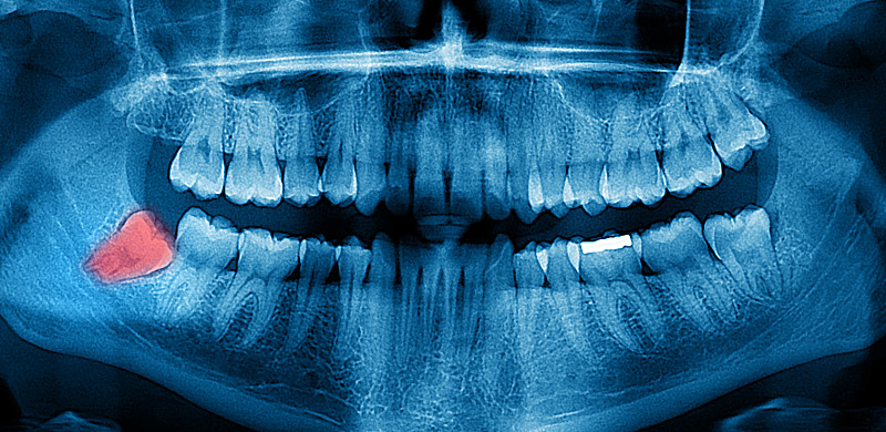 x光,口腔卫生,全景,智慧,x光片,人的牙齿,牙龈,颌骨,骨质疏松症,医学扫描