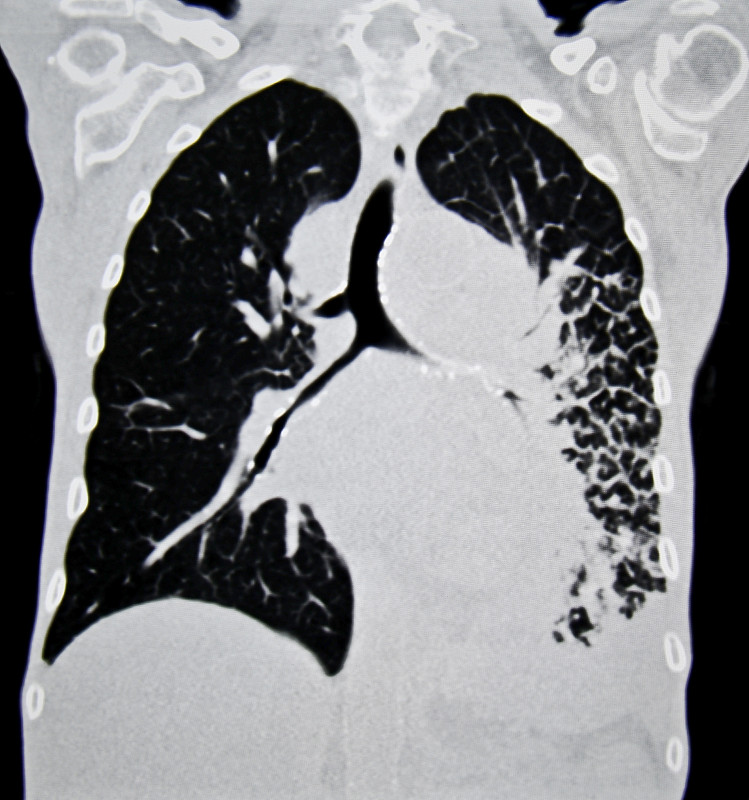 肺癌,ct检查,垂直画幅,cat扫描仪,无人,2015年,科学成像技术,吸烟问题,摄影,生病