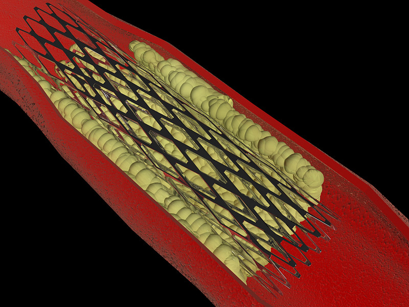 血管成形术,内支架,人体动脉,闭塞,血流,动脉硬化症,动脉硬化,心脏手术,冠状动脉,血凝结
