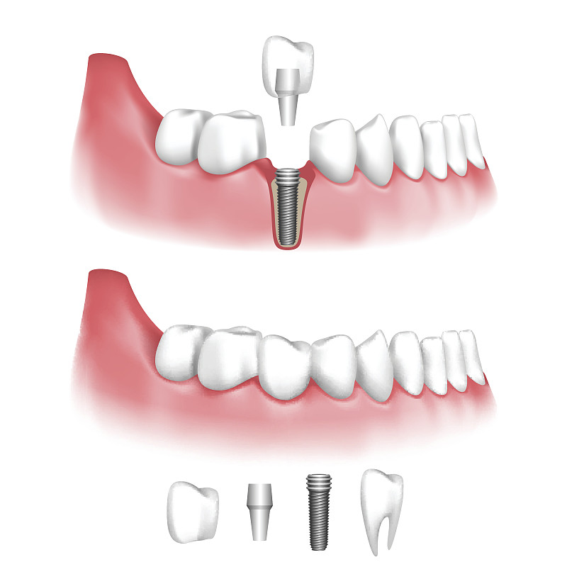 牙移植,牙冠,假牙,牙龈,绘画插图,符号,人的嘴,颌骨,科学,有凹痕的