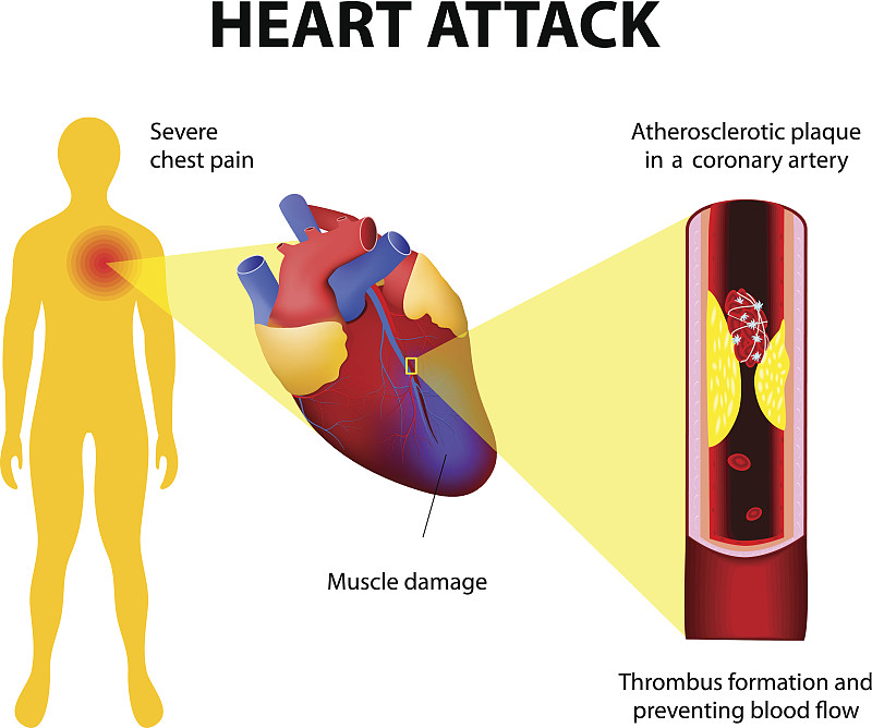 心脏病发作,动脉硬化症,冠状动脉,胸痛,心脏搭桥手术,主动脉,血凝结,维管束,心血管系统,生物学