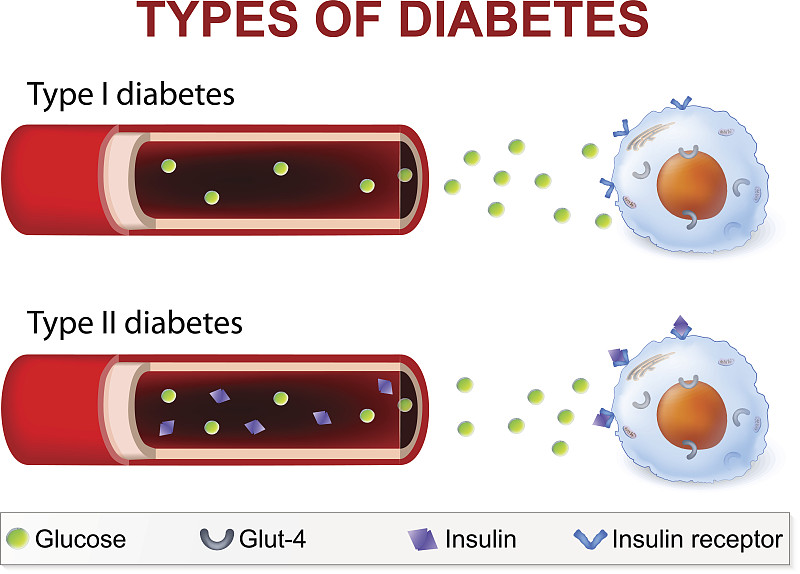 糖尿病,健康保健,化学,生物化学,新陈代谢,一个人,数字1,葡萄糖,多糖症,血糖过低