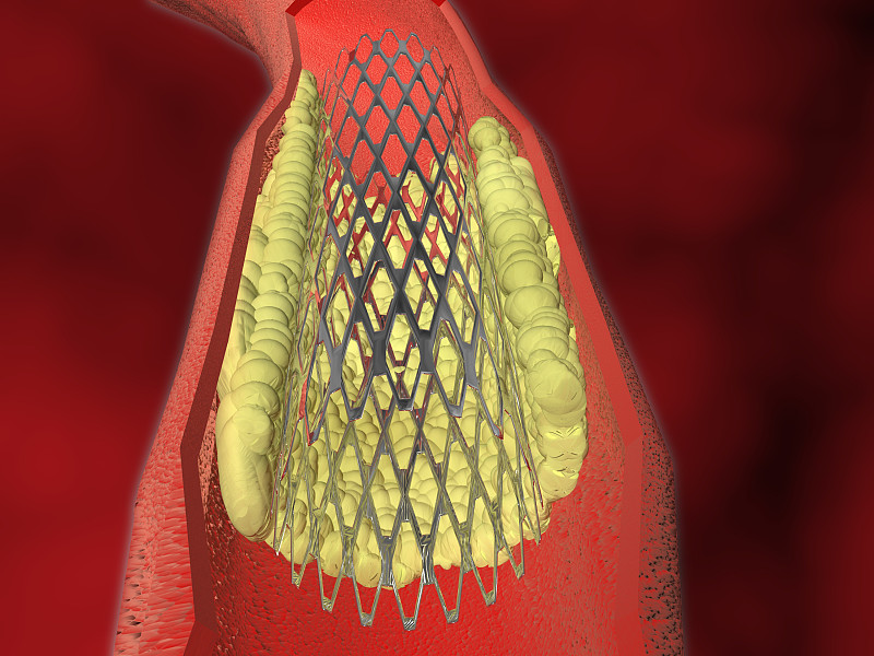 内支架,血管成形术,闭塞,心脏手术,血流,动脉硬化症,动脉硬化,高血压,缺血