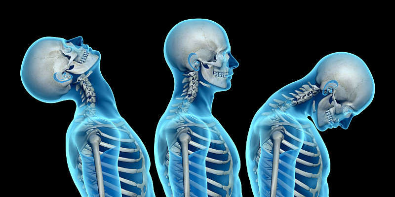 颈部挥鞭样损伤,脖子,生理学,身体受伤,图像特效,形态学,颈椎,3d扫描,脊椎