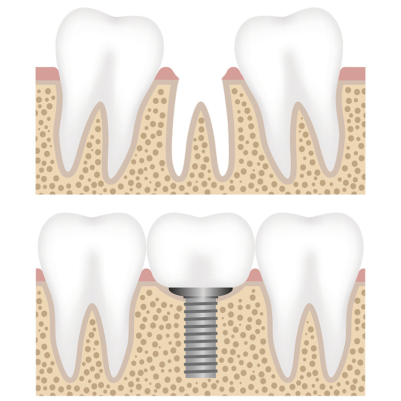 牙移植,王冠,迷路,牙本质,牙冠,缺牙,牙龈,根部,绘画插图,人的嘴