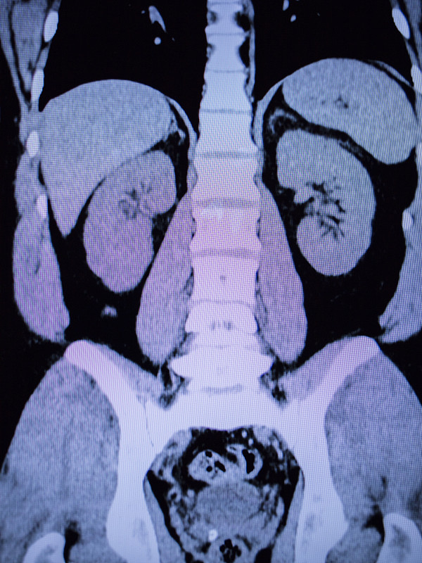 ct检查,肾结石,膀胱,造影扫描机,cat扫描仪,x光,医疗诊断工具,垂直画幅,x光片