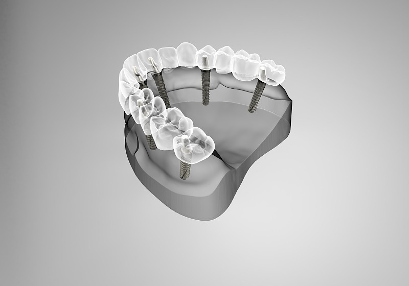 三维图形,牙移植,假肢,假牙,龋齿,口腔卫生,牙科诊所,牙科设备,磨牙,补牙