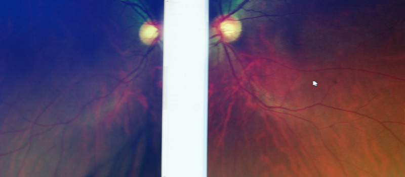 视力测验,视网膜静脉,视网膜动脉,视神经,视网膜扫描,眼部扫描仪,动脉x光照片,视网膜,眼球,大规模的放大
