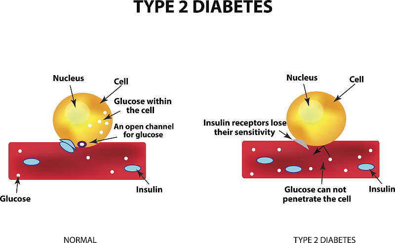 2型糖尿病,葡萄糖,胰岛素,血糖检测,细胞,绘画插图,矢量,专心,生长,下降