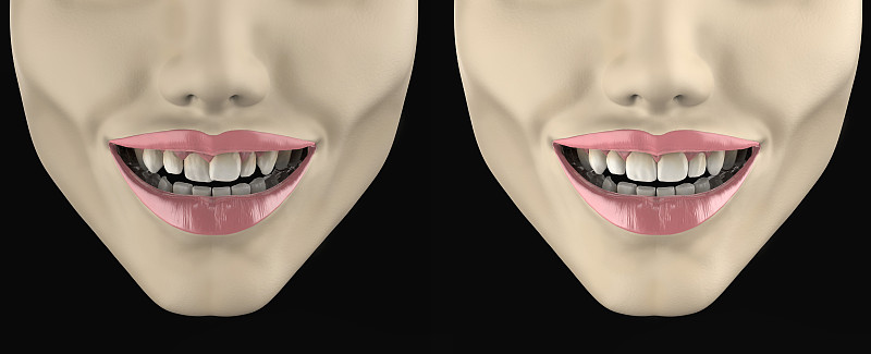 口腔卫生,三维图形,牙移植,假牙,假肢,龋齿,牙科诊所,牙科设备,牙医,水平画幅