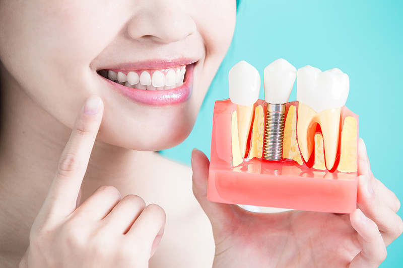 口腔卫生,概念,假牙粘合剂,牙移植,牙冠,牙科设备,牙齿,假牙,牙医