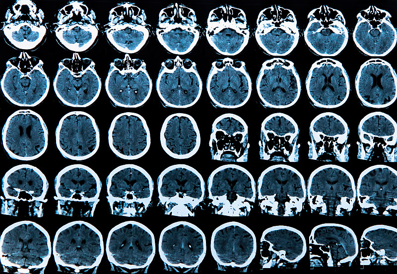 人脑,额骨,胼胝体,额叶,神经影像,眼窝,造影扫描机,相位图像,鼻腔,硬化症