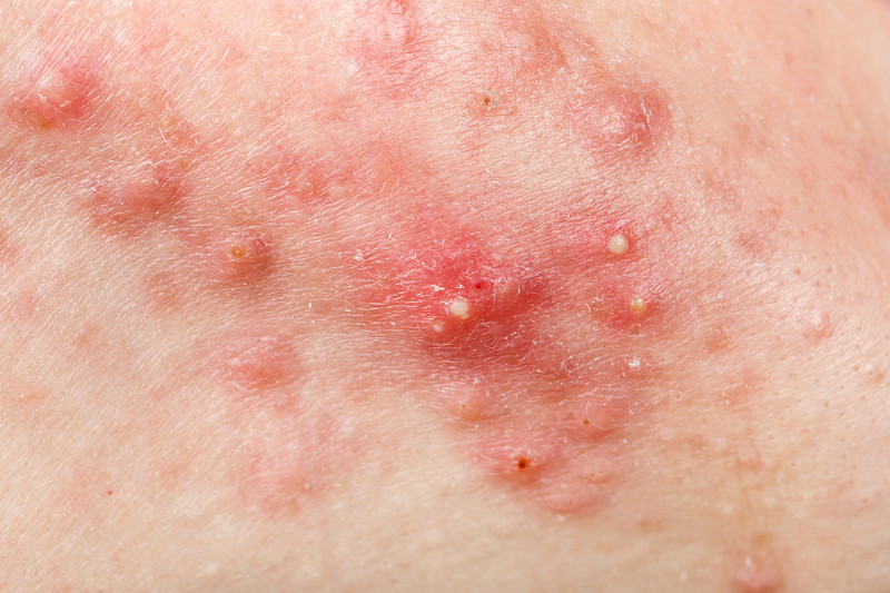 粉刺,皮肤,胞囊的,皮脂腺,水痘一带状疱疹,水痘,麻疹,药物的副作用,毛孔,皮肤状况