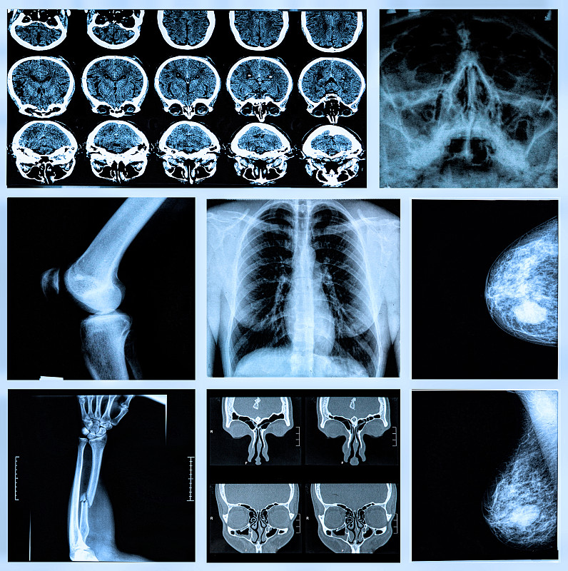 骨骼,射线成像,鼻窦,mri扫描仪,脑肿瘤,cat扫描仪,x光片,脊柱,胸部,人类骨架