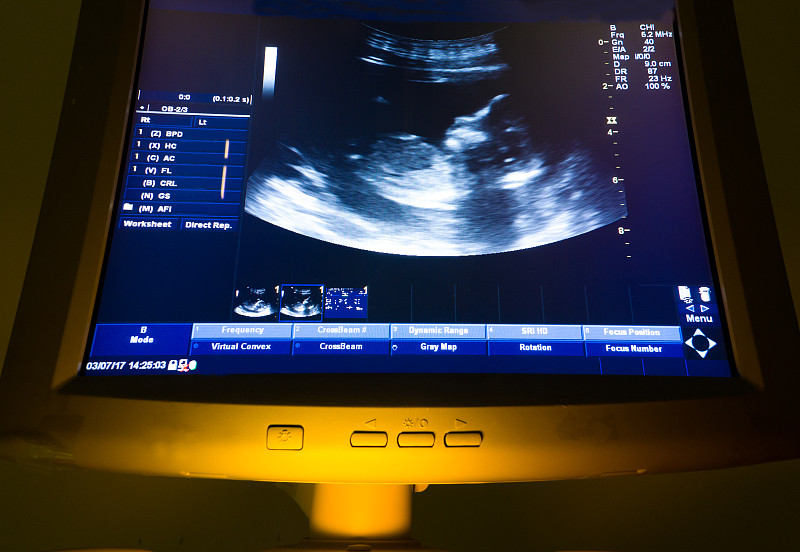 超声波,婴儿,母亲,投影屏幕,贞德,显示器,3d超声,3d扫描,胎儿