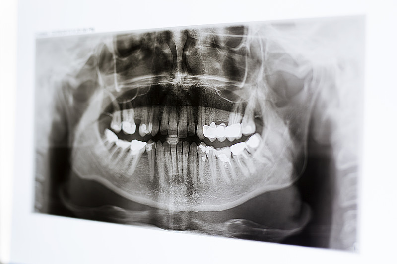 x光,人的嘴,牙齿,水平画幅,医疗流程,影片,牙医,颌骨,健康保健