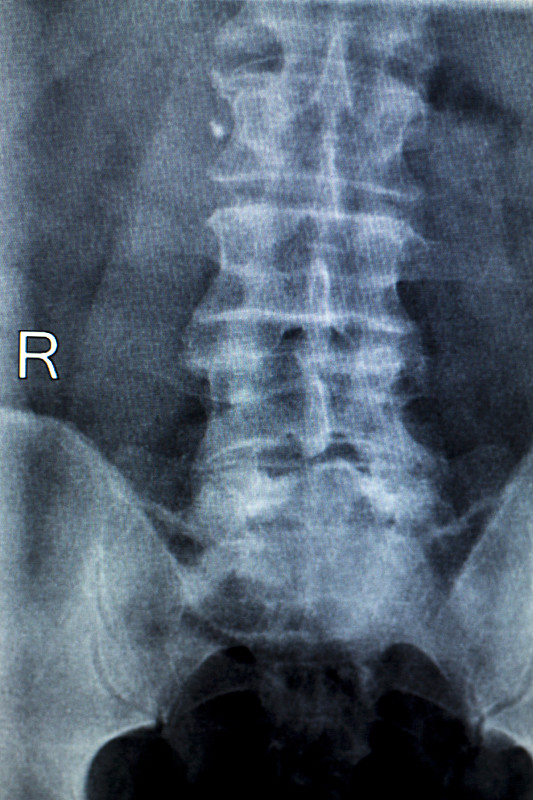 脊柱,骨盆,病人,臀,老年人,x光片,关节炎,腰部以下,腰痛,整形外科