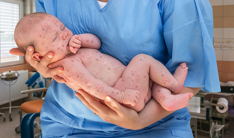 麻疹,水痘,新生儿,婴儿,风疹病毒,产科病房,单纯疱疹病毒,皮肤状况,天花病毒,疹