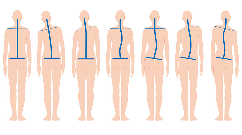 姿态不雅,生物医学插图,脊骨神经科矫正