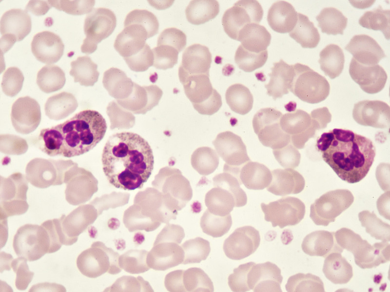 白细胞,嗜碱细胞,单核细胞,海洋性贫血,嗜中性粒细胞,嗜曙红细胞,血小板,贫血症,白血病,红细胞
