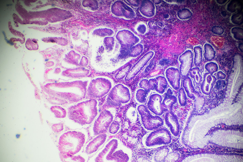 Carcinoma,of,the,large,intestine,(well?diff.,tubular,adenocarcinoma),under,microscope