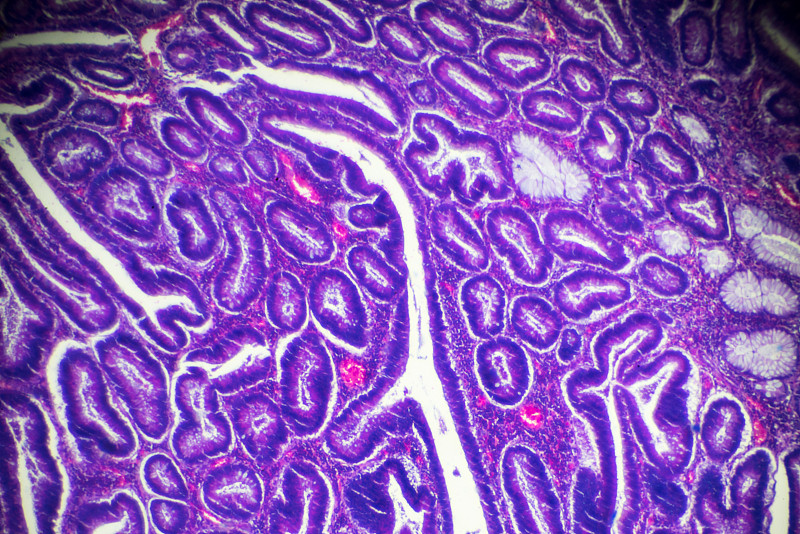 Carcinoma,of,the,large,intestine,(well?diff.,tubular,adenocarcinoma),under,microscope