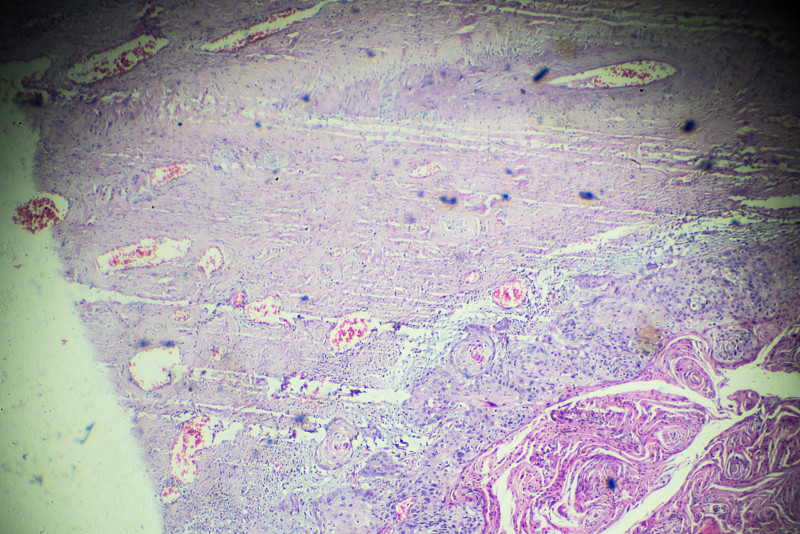 Cervical,Cancer,(Squamous,cell?carcinoma),under,light,microscopy