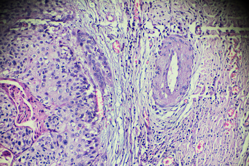 Cervical,Cancer,(Squamous,cell?carcinoma),under,light,microscopy