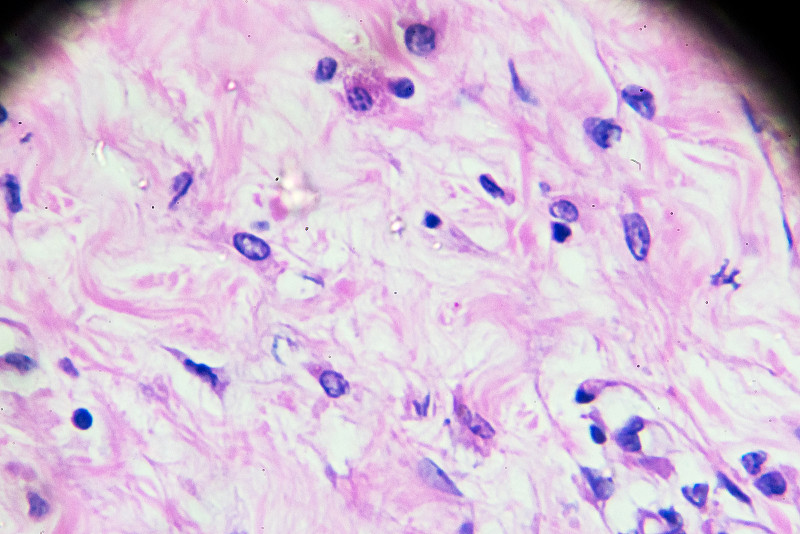 Hodgkin’s,cells,disease,,Lymphoma,,HL,under,microscopy