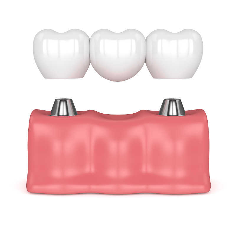 隆胸手术,口腔卫生,三维图形,合成图像,人造的,牙冠,假牙,牙龈,水平画幅,固定的