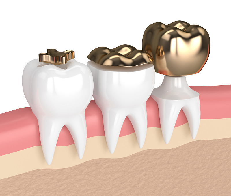 三维图形,黄金,牙齿,口腔卫生,合成图像,牙冠,假牙,牙龈,水平画幅,绘画插图
