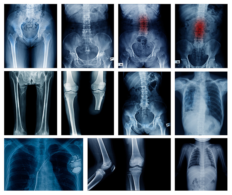 x光,骨盆,人类肺脏,脊柱,骨骼,人类骨架,膝,儿科医师,关节,肩