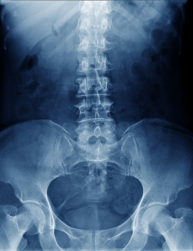脊柱,骨盆,人,臀,x光片,垂直画幅,身体受伤,人类骨架,股骨,科学